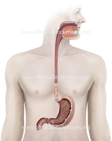 Stent with Tumour in Oesophagus with Figure Background