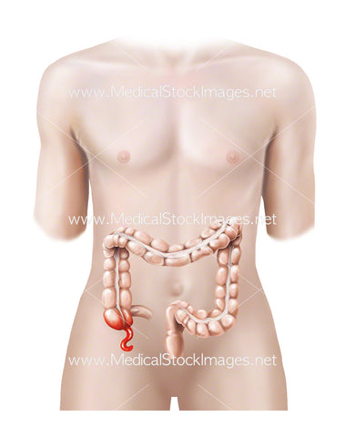 Androgynous Figure with Inflamed Appendix