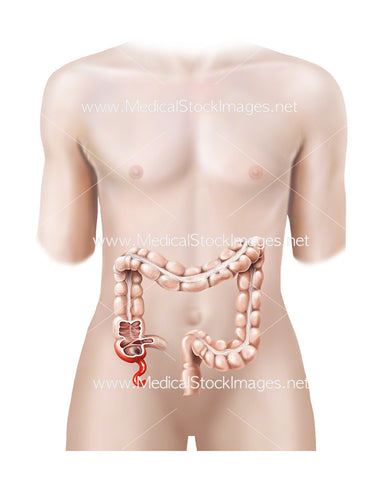 Androgynous Figure Inflamed Appendix