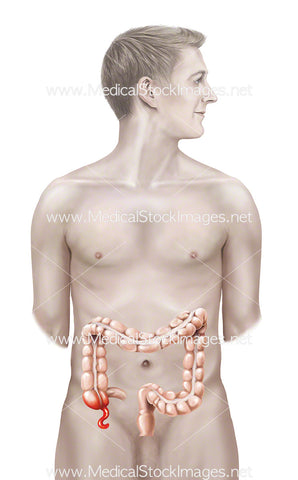 Male Figure with an Inflammed Appendix
