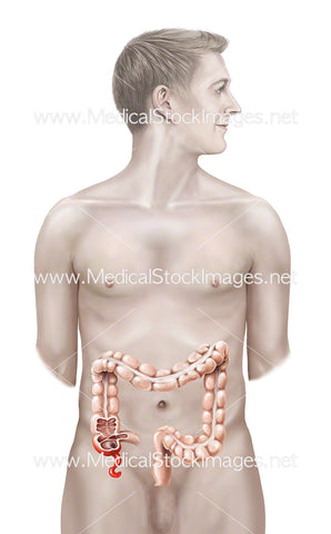 Male Figure with Inflamed Appendix