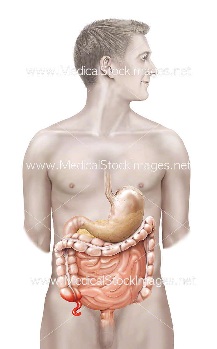 Appendix In Men Male Figure with an Inflamed Appendix in situ – Medical Stock Images ...