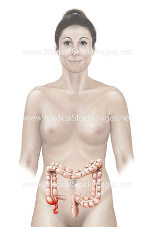 Female figure with an Inflamed Appendix