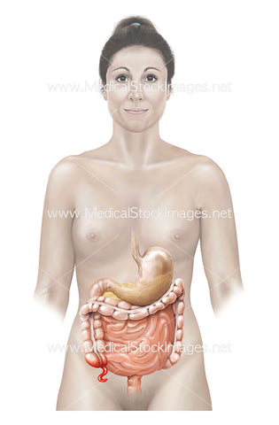 Female with an Inflamed Appendix