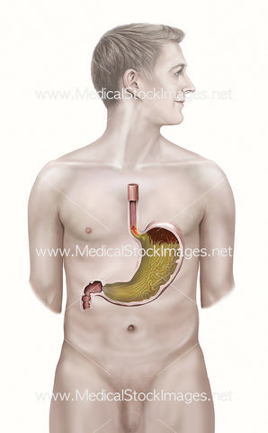 Male Figure with Stomach GERD