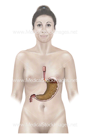 Female Figure with Stomach GERD