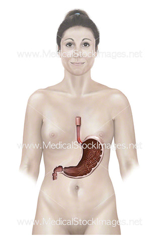 Female Figure with Stomach with Mallory Weiss Tear