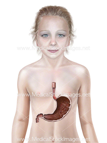 Child Stomach Mallory Weiss Tear