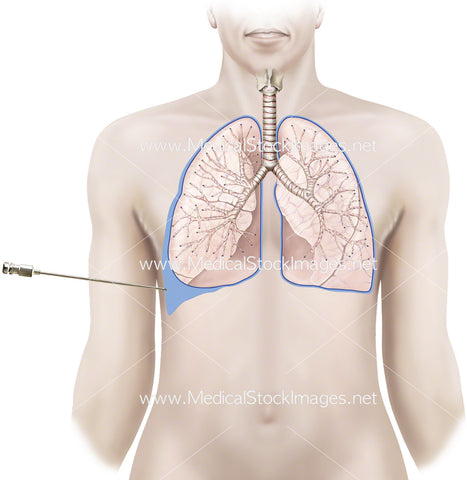 Lung Biopsy