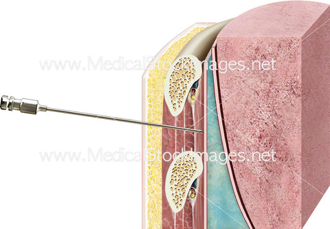 Lung Biopsy