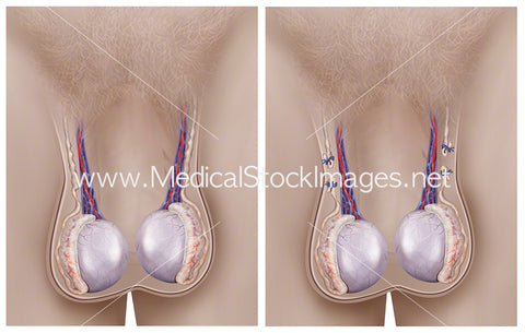 Before and After Vasectomy Procedure