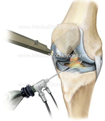 Knee Arthroscopy with Torn Ligament