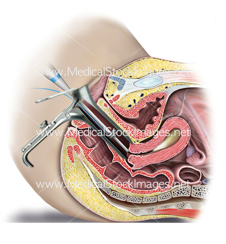 Hysteroscopy Procedure