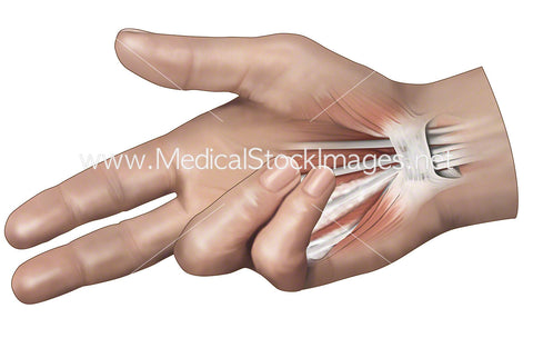 Dupuytren’s Contracture