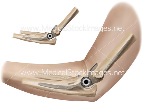 Elbow Prosthesis