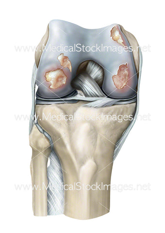 Rheumatoid Arthritis of the Knee