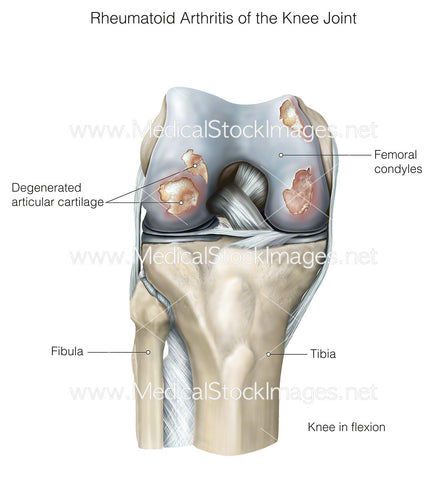 Rheumatoid Arthritis