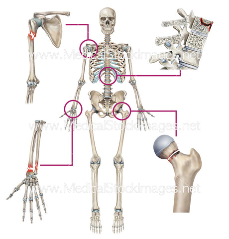 Fractures to Various Parts of the Skeleton