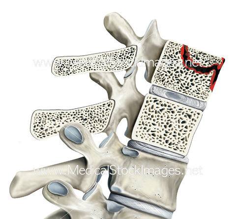 Degenerated Bone in the Spine