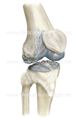 Arthritis in the Knee Joint