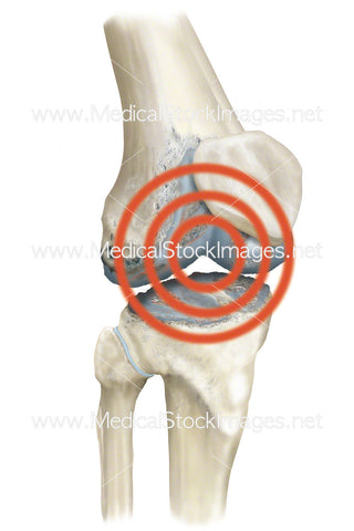 Pain Radiating from Knee with Arthritis