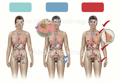 Menopause Hormone Replacement Chart