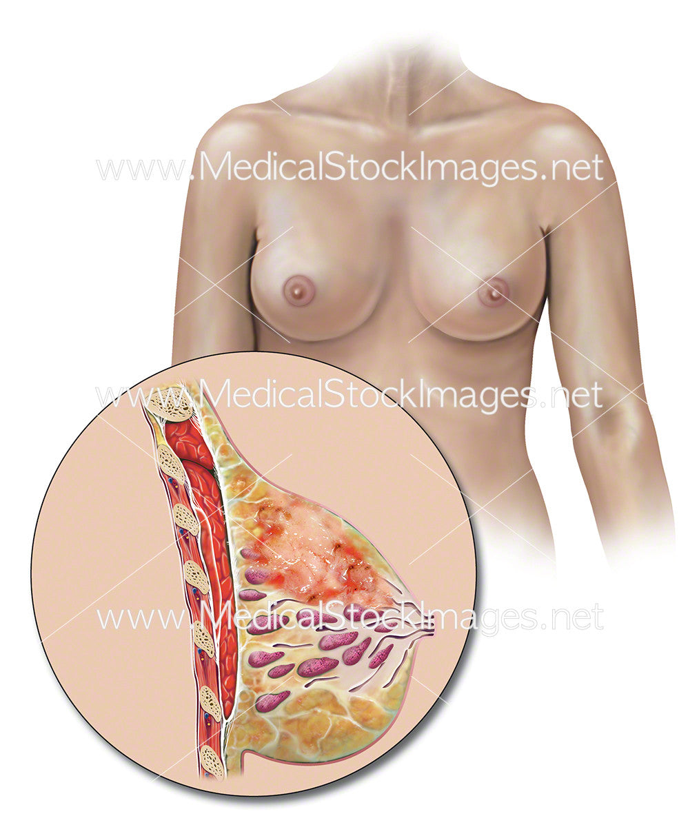 Female Body with Breast and Tumour in Cross Section – Medical