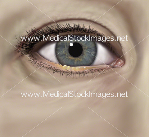 Meibomian Gland Dysfunction in the Eye