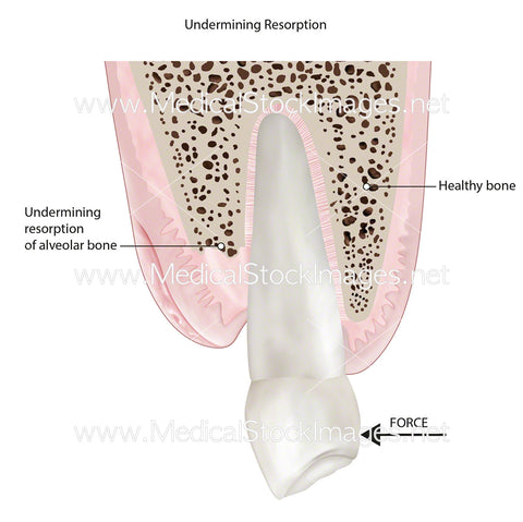 Undermining Resorption in the Tooth