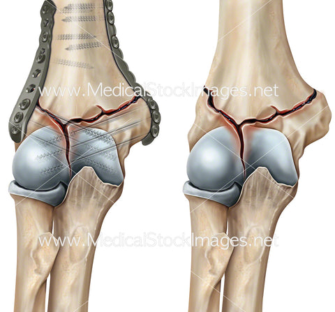 Elbow Fracture and Repair