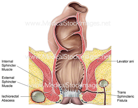 Ischiorectal Abscess (Labelled)