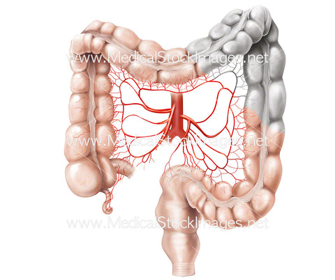 Left Hemi Colectomy to Treat Colon Cancer