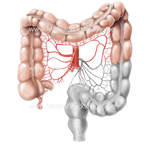 Lower Anterior Resection to Treat Colon Cancer