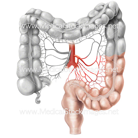 Right and Extended Hemi Colectomy to Treat Colon Cancer