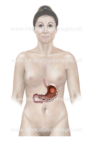 Female Figure with Stomach Polyp