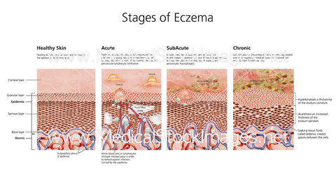 Stages of Eczema - Labelled