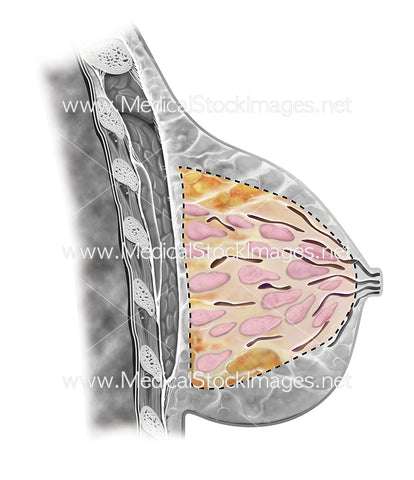 Subcutaneous Mastectomy
