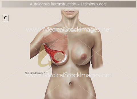 Autologous Reconstruction – Surgery Step C - Labelled