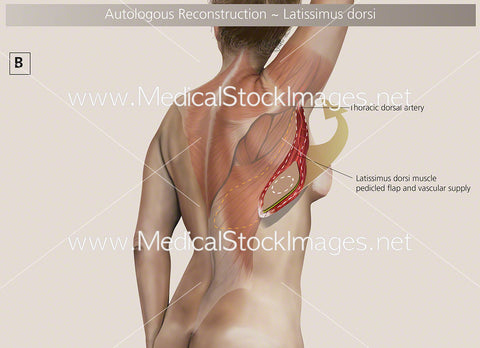 Autologous Reconstruction – Surgery B - Labelled