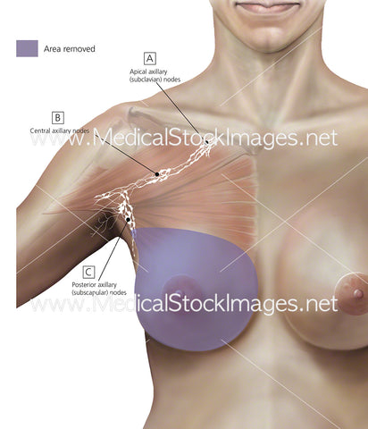 Total Mastectomy White Background
