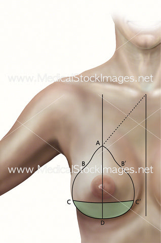 Wise Pattern Method of Breast Reduction