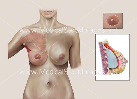 Autologous Reconstruction – Surgery D