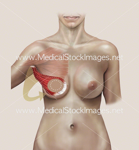 Latissimus Dorsi or Myocutaneous (LD) Flap Surgery Anterior View No Labels