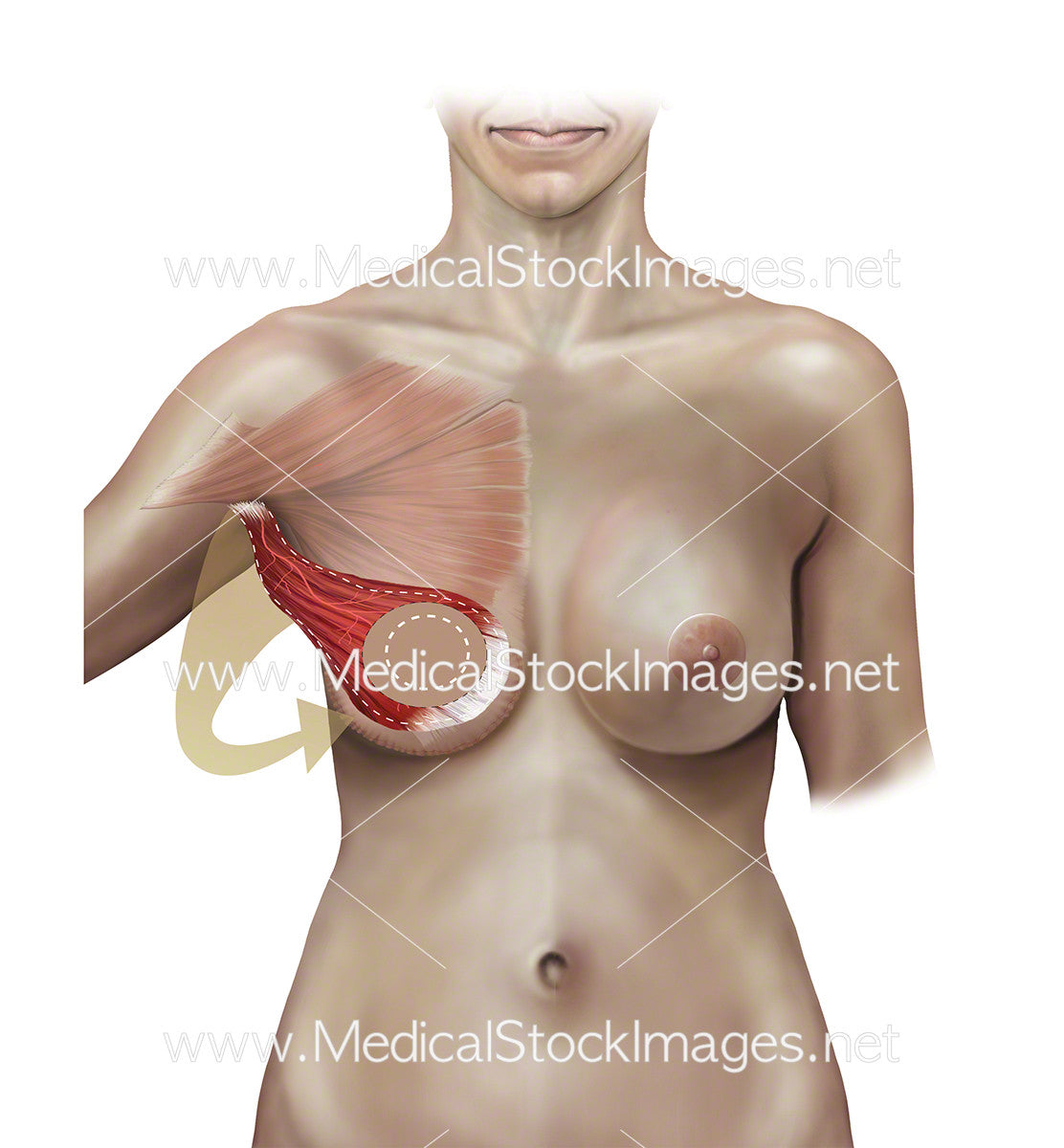 Stage C Autologous Breast Reconstruction – Medical Stock Images