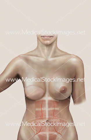 Transverse Rectus Abdominis with Mastectomy Scar (TRAM FLAP)