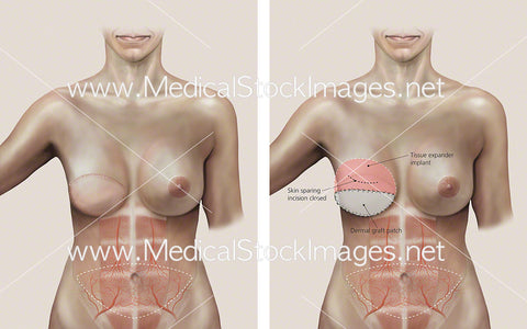 Two Stages of Transverse Rectus Abdominis Surgery – Labelled (TRAM FLAP)