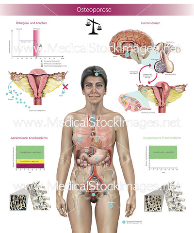 Osteoporose – German Labelling