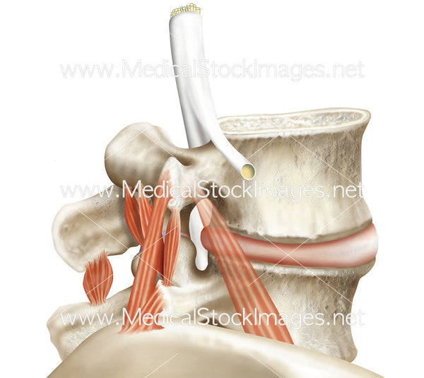 Vertebrae under Compression with Interspinal Muscles – Medical Stock ...