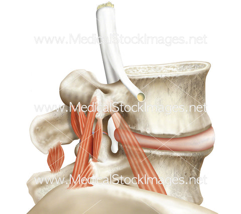 Vertebrae under Compression with Interspinal Muscles