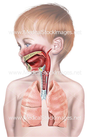 Upper Airway of Young Child showing Inflamed Pharynx